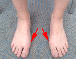 Hallux valgus