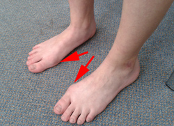 Hallux valgus
