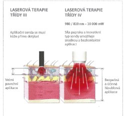 Terapie laserem